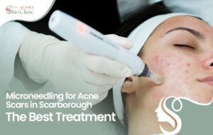 Microneedling Scarborough