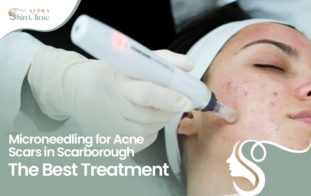 Microneedling Scarborough