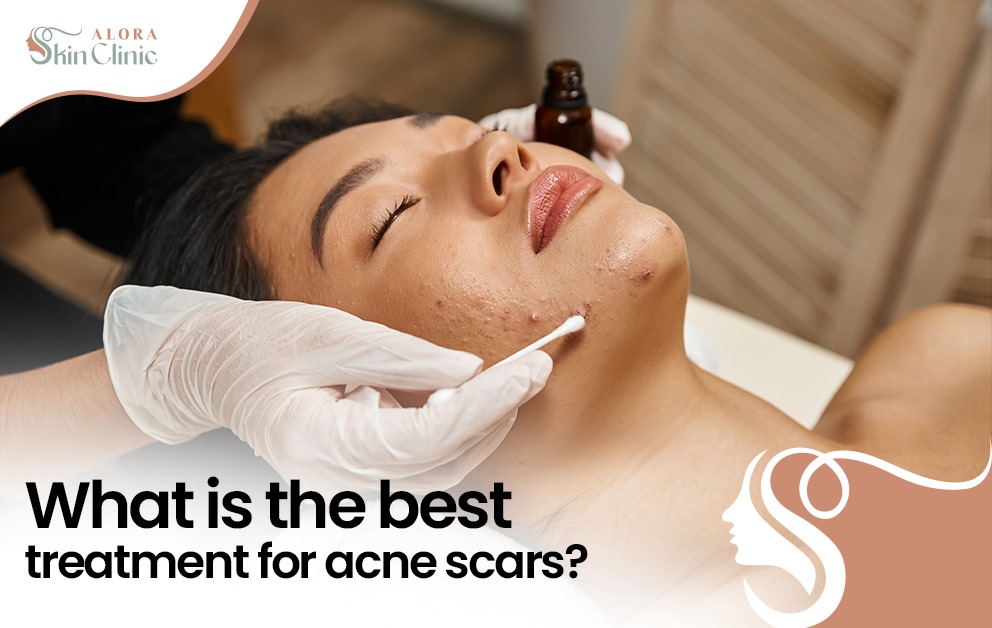 what is the best treatment for acne scars