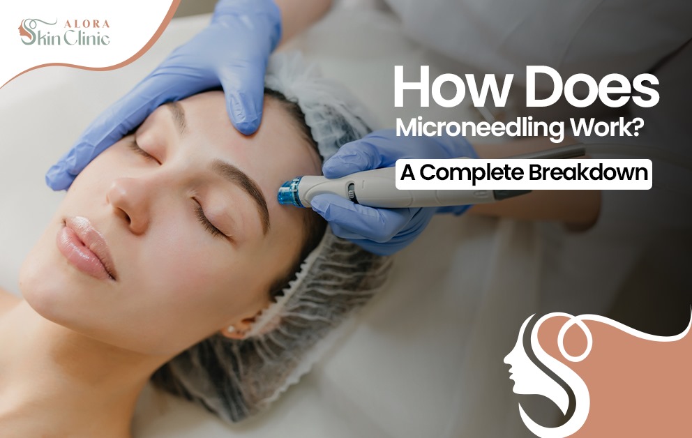 How does microneedling work