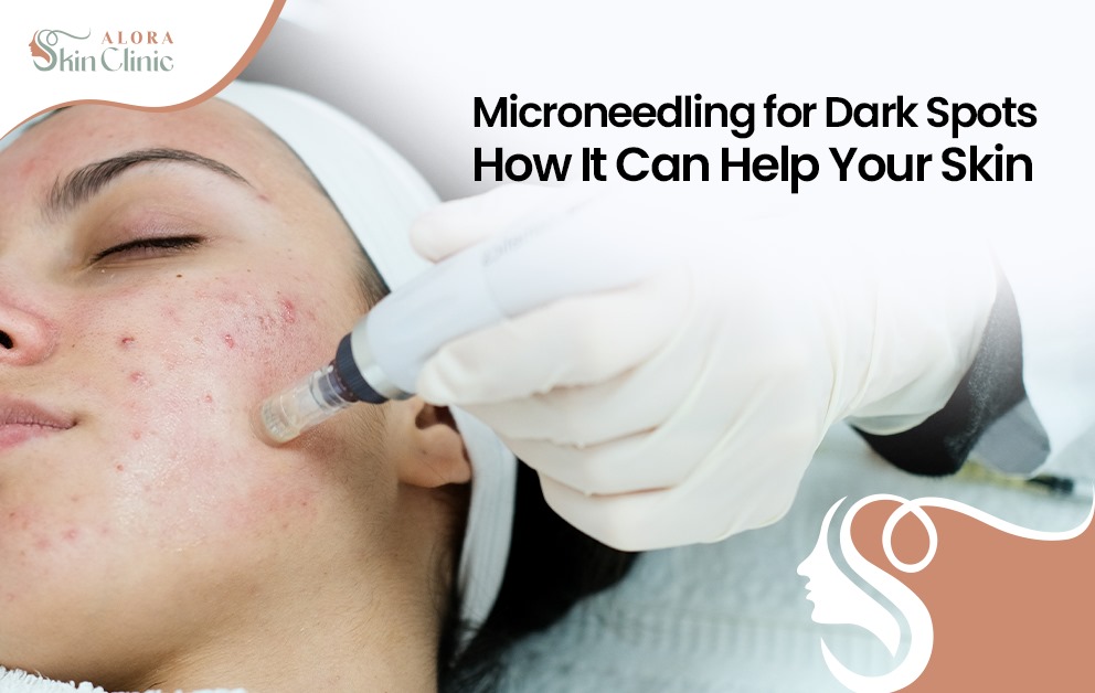 microneedling for dark spots