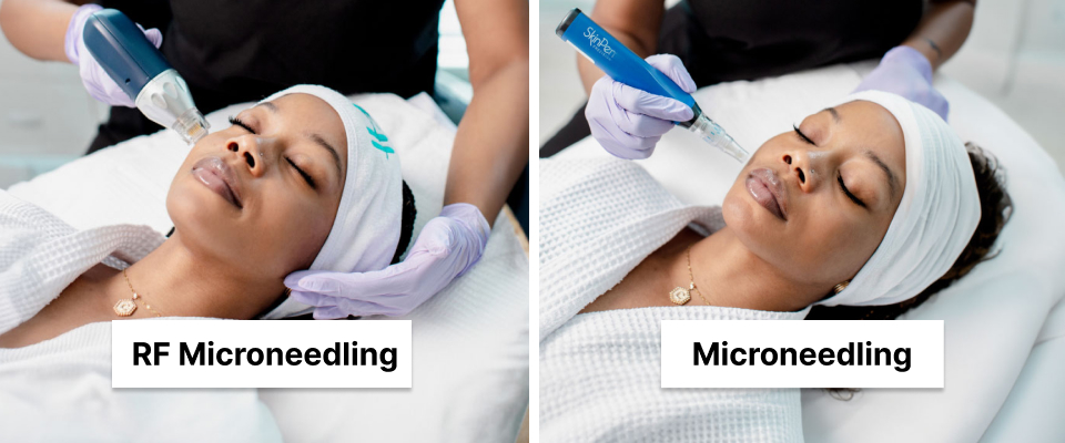 Microneedling & RF Microneedling