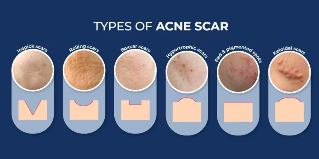 Why It Depends on Your Scar Type