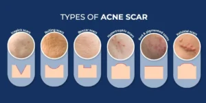 Why It Depends on Your Scar Type