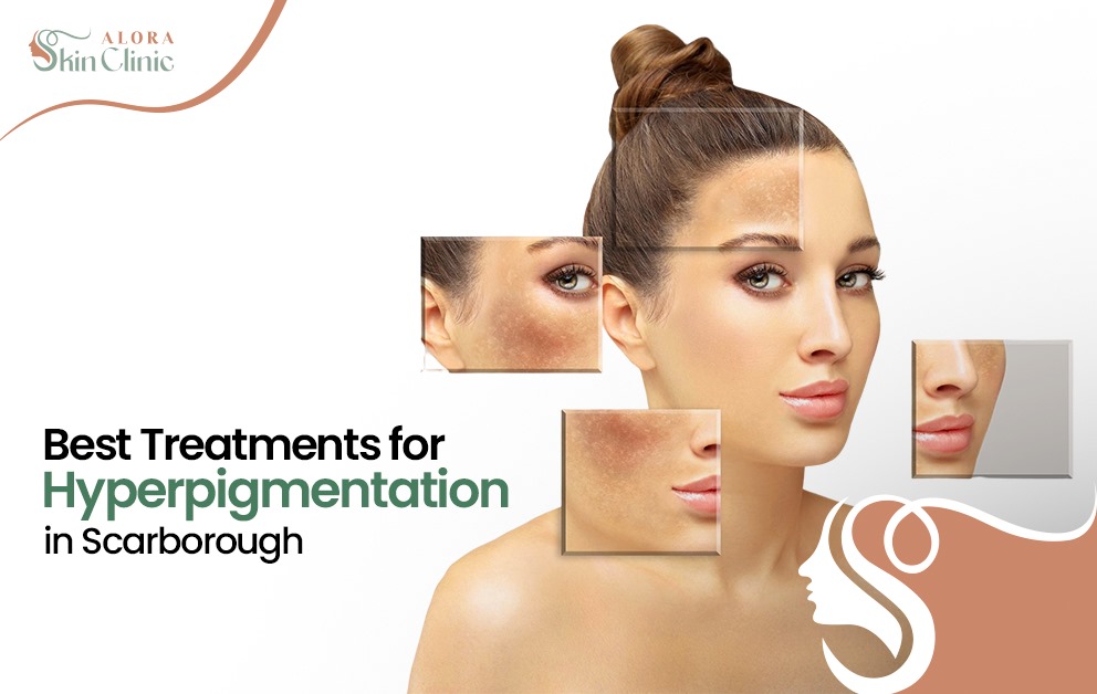 Pigmentation Treatments