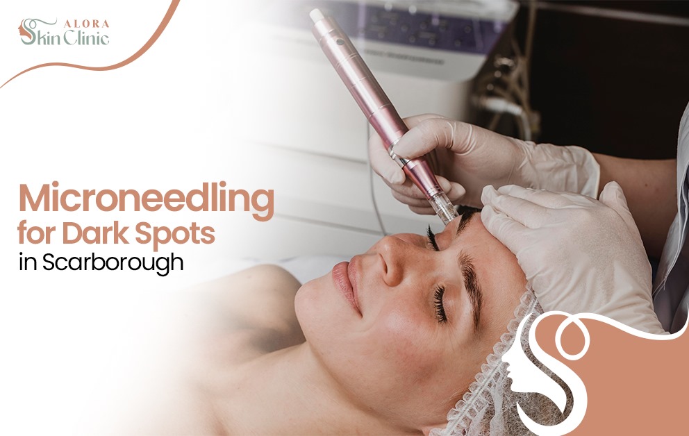 Microneedling for Dark Spots