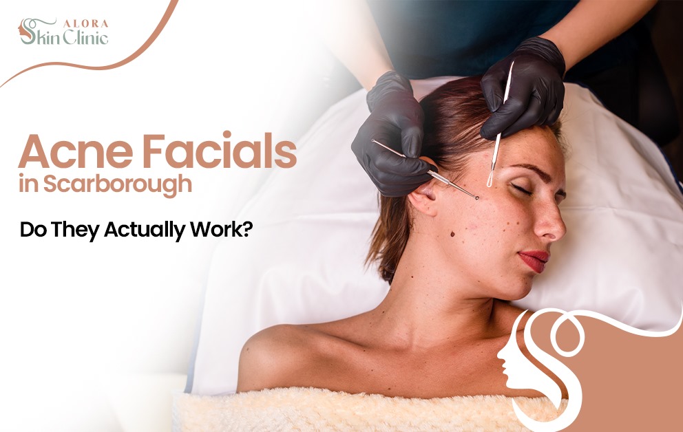 acne facial Scarborough