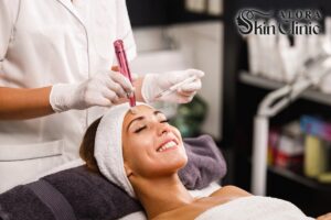 Microneedling treatment for acne scars at Alora Skin Clinic in Scarborough