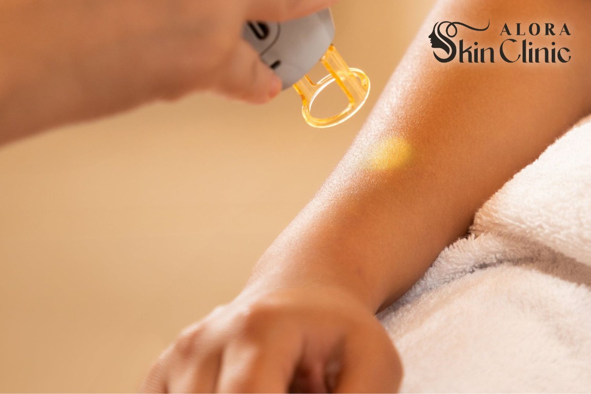 Laser hair removal handpiece treating a forearm at Alora Skin Clinic Scarborough