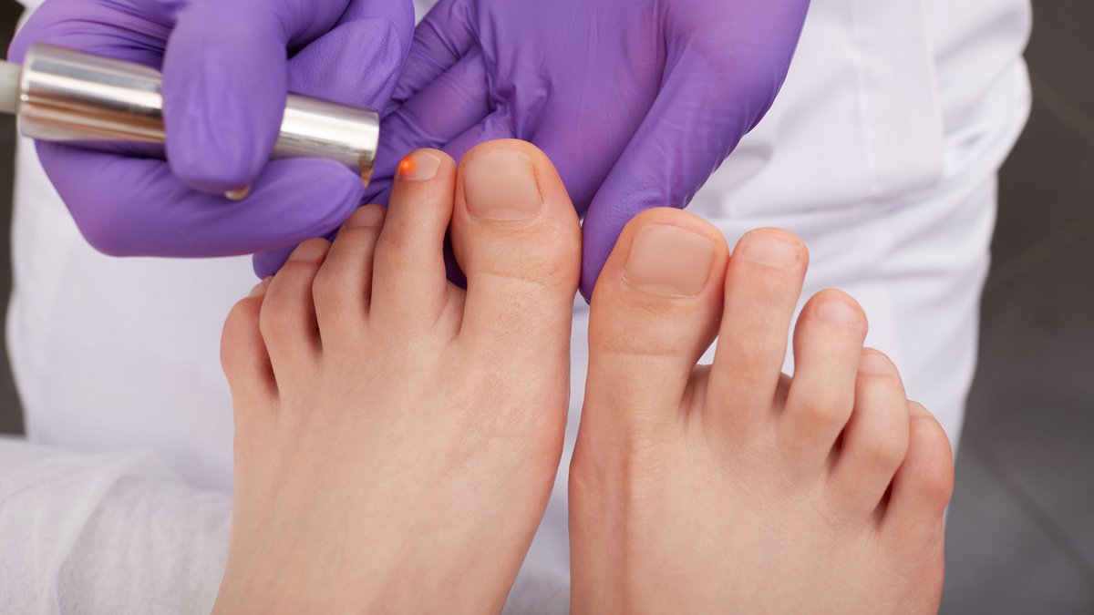 Calm, clinical laser toenail fungus session at Alora Skin Clinic in Scarborough