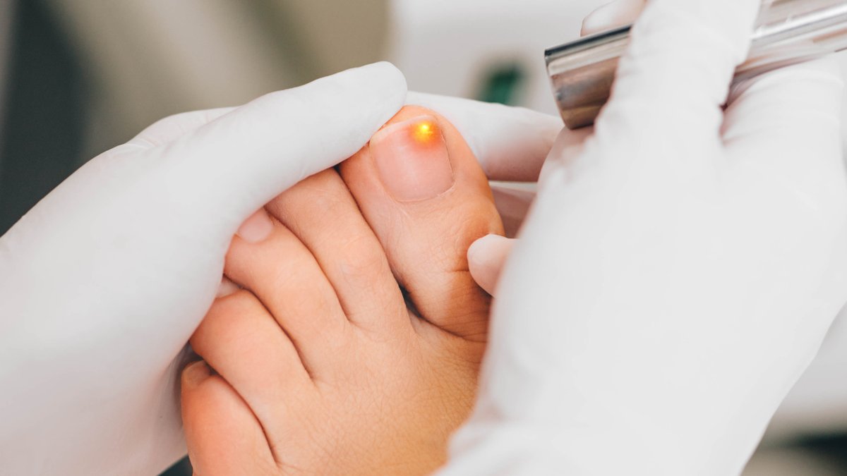 Laser treatment being applied to a toenail at Alora Skin Clinic in Scarborough