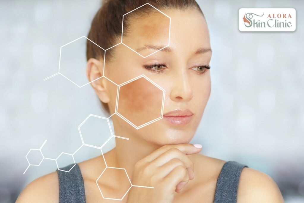 Woman with sun spots and melasma on her face, a common form of pigmentation treated at Alora Skin Clinic in Scarborough