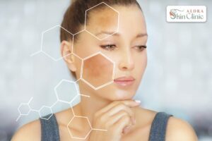 Woman with sun spots and melasma on her face, a common form of pigmentation treated at Alora Skin Clinic in Scarborough