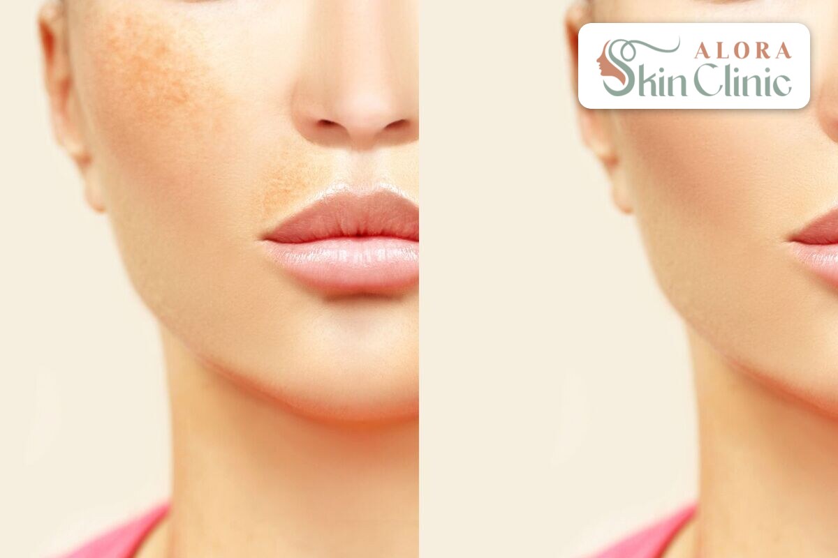Before and after showing more even skin tone after hyperpigmentation treatment at Alora Skin Clinic Scarborough