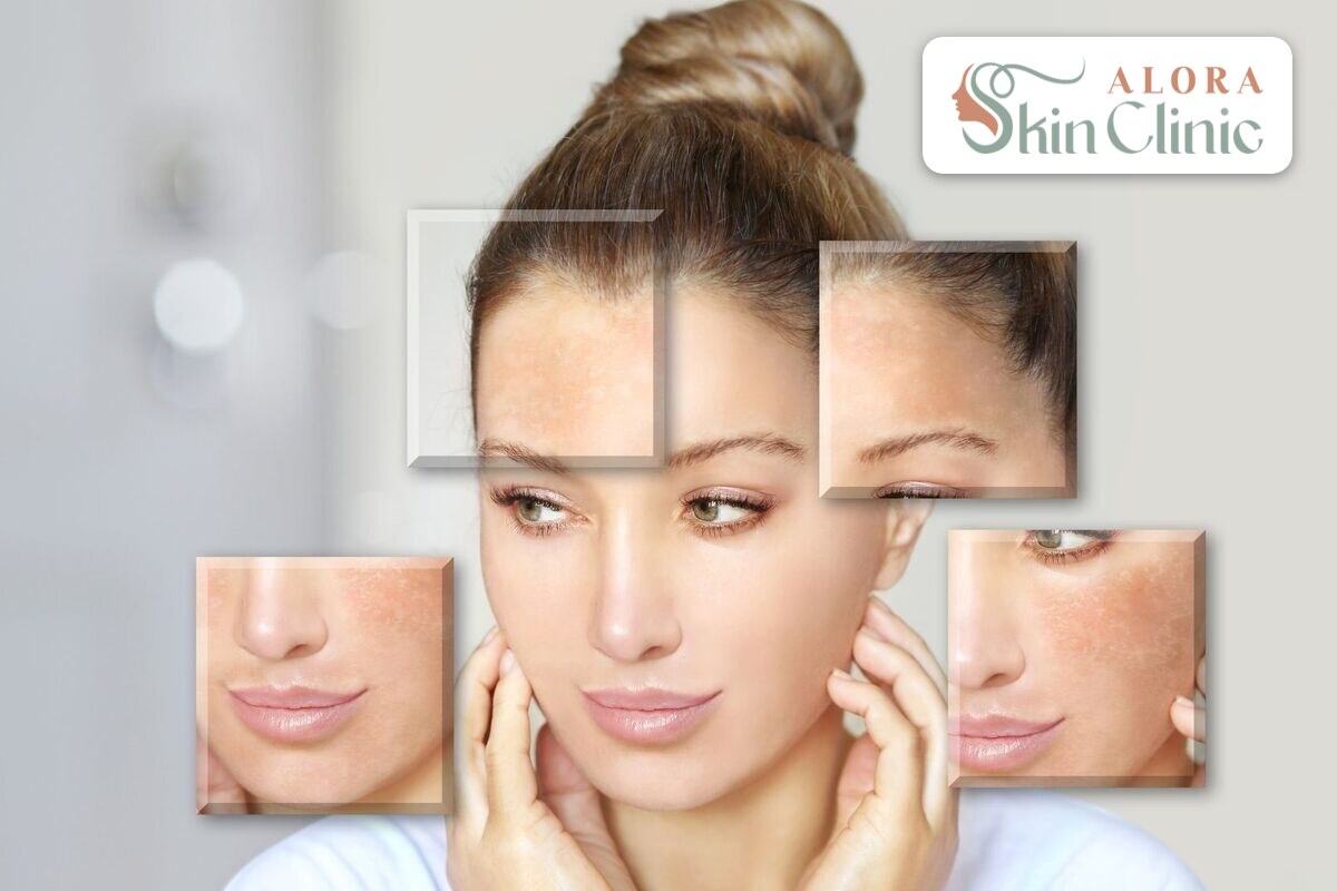 Close-up showing sun spots and pigmentation on the cheeks, treated at Alora Skin Clinic Scarborough