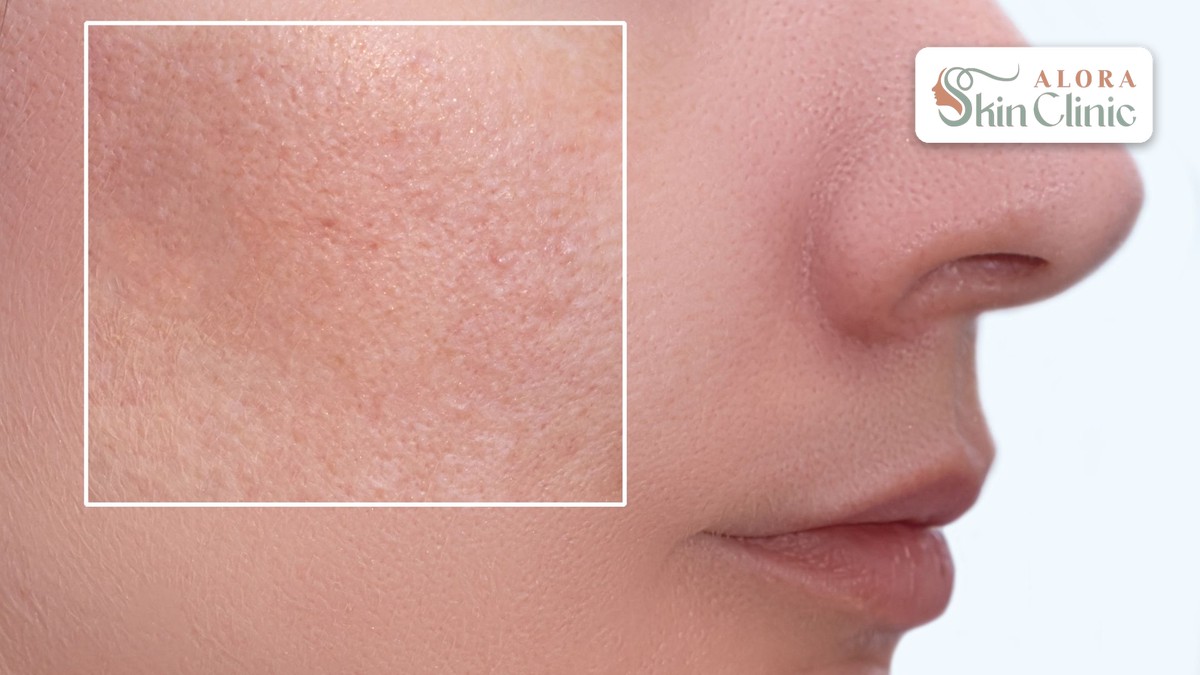 Close-up of a cheek and nose showing enlarged pores and skin texture