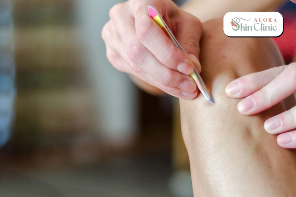 Person tweezing an ingrown hair on a smooth leg in Scarborough