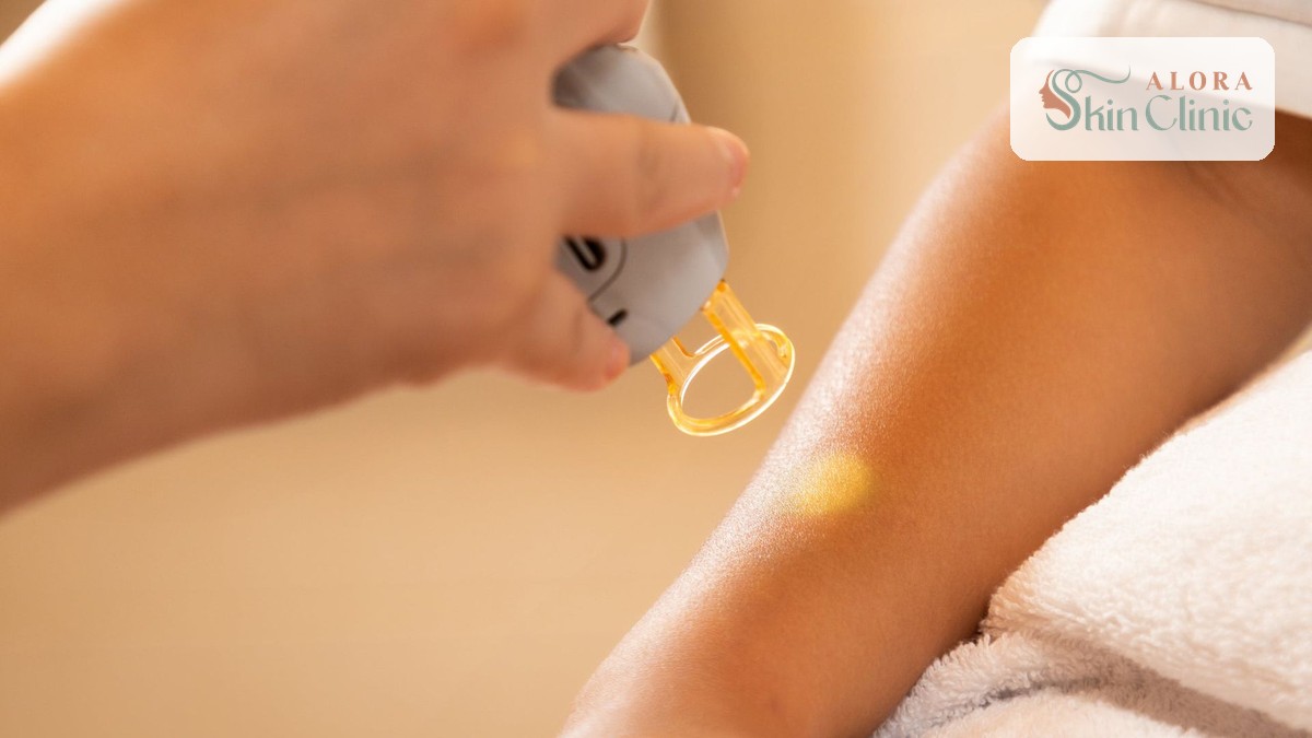 Laser hair removal session on the arm at Alora Skin Clinic in Scarborough