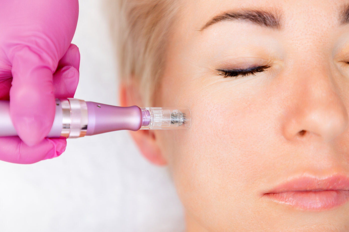 Microneedling