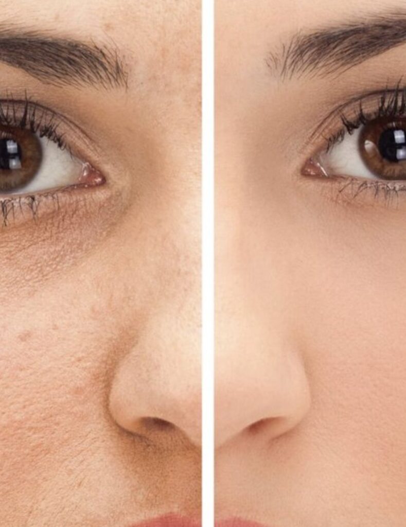 Before and after pigmentation treatment at Alora Skin Clinic in Scarborough