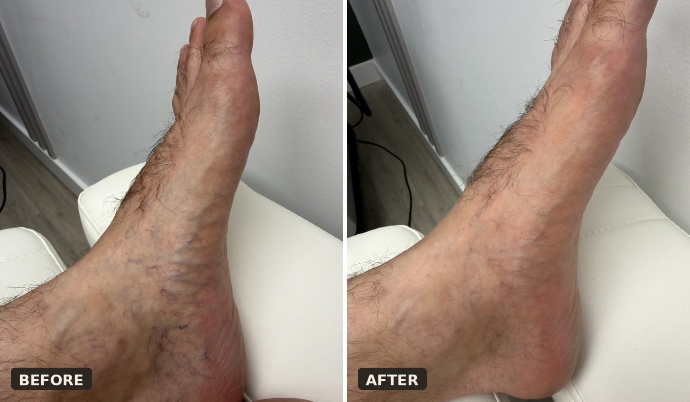 Spider vein treatment before and after at Alora Skin Clinic in Scarborough