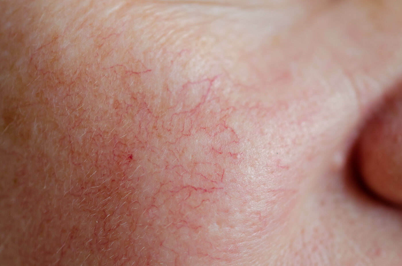 Spider Vein Removal