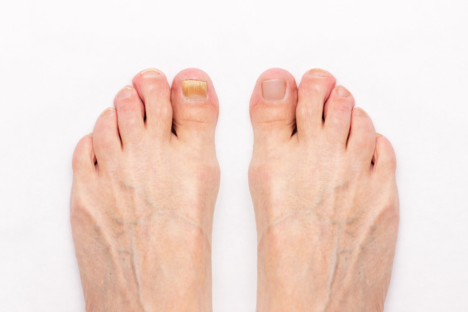 Laser Toenail Fungus