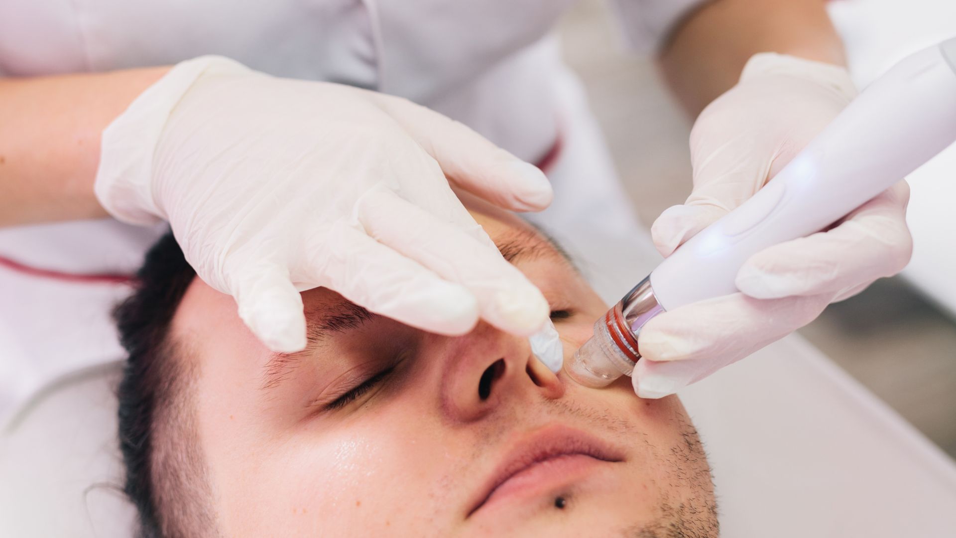 Close-up of a facial clearing congestion around the nose on a male client in Scarborough