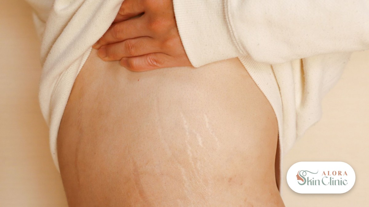 Stretch marks on the hip