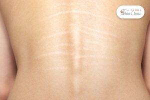 Silvery stretch marks across the lower back