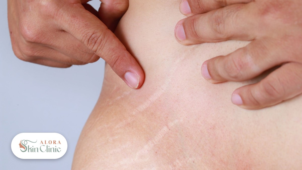 Close-up of stretch marks on the side of the torso